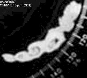 Closeup of tornadic superell from St. Louis radar image from 05/29/1982 at 3:10 p.m. CDT